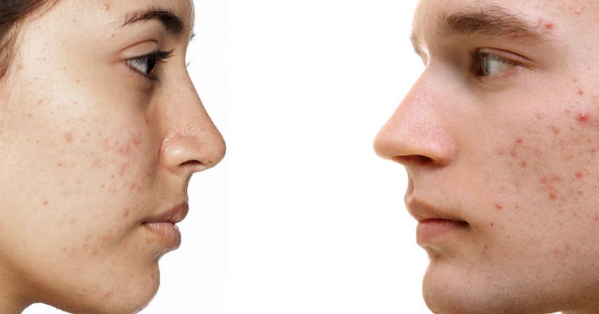 Так выглядет акне