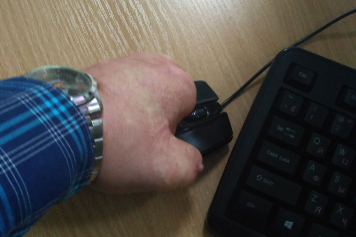 Ампутированные пальцы рук. Ампутировали палец на руке