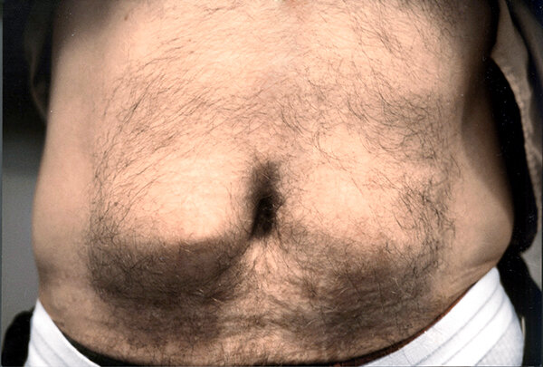 Липогипертрофия