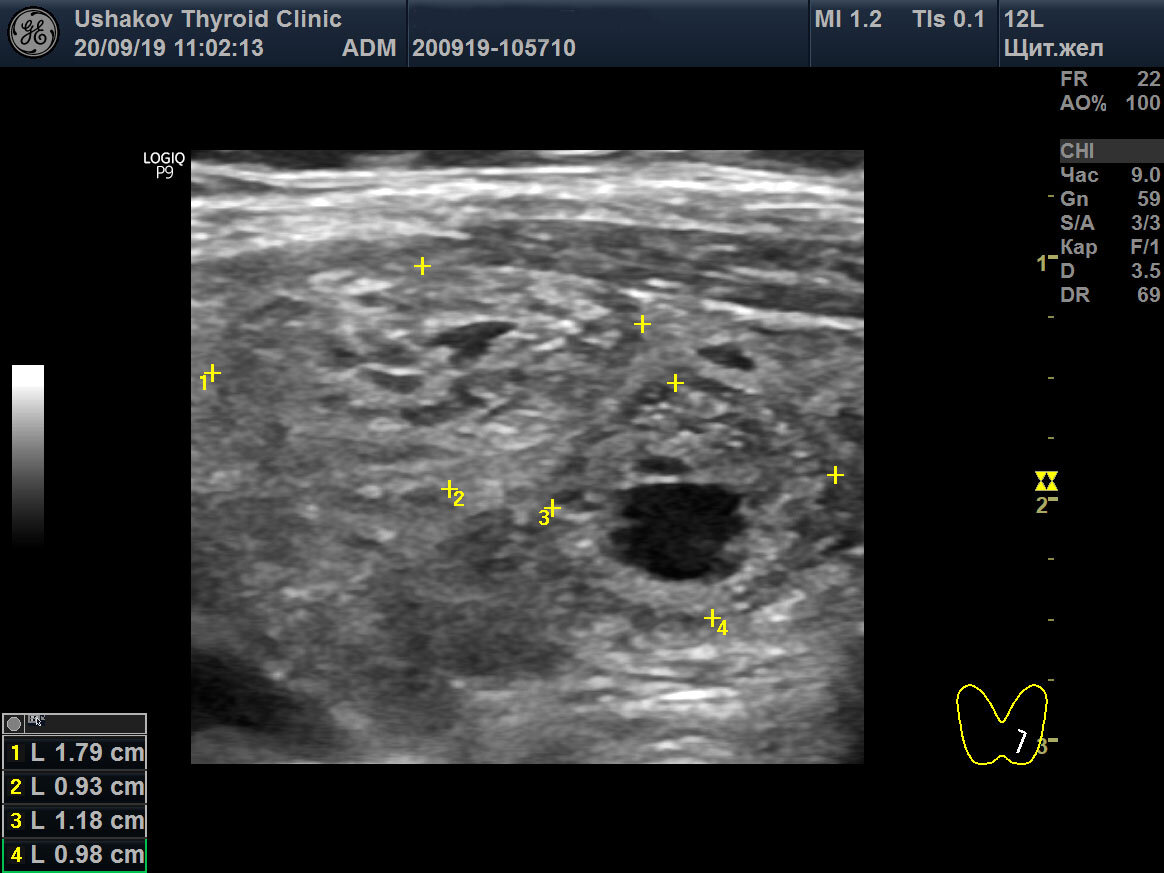 Узлы в щитовидной железе размеры. Узлы щитовидной железы на УЗИ.
