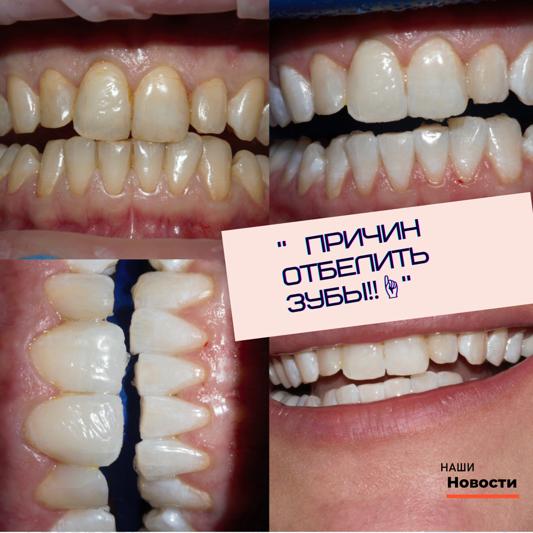 «🔟 причин отбелить зубы‼️☝️»

1️⃣ Белоснежная улыбка повышает самооценку 💪🏻 После отбеливания ваша уверенность в себе возрастёт в разы💪🏻, а красивая, белоснежная улыбка просто не будет сходить с вашего лица 😃
⠀
2️⃣ Это безопасно 💯. Профессиональные методы отбеливания не только НЕ повреждают зубы, а наоборот - укрепляют эмаль! ❗Но помните, что только профессиональное отбеливание под контролем стоматолога безопасно👆
⠀
3️⃣ После отбеливания у пациента примерно на 40% снижается частота возникновения зубного камня, кариеса и пародонтита❗
⠀
4️⃣ Красивая улыбка придаёт статусность🔝 Особенно, если ваша работа тесно связана с общением с людьми🙀🤩
⠀
5️⃣ Результат будет радовать вас долгое время😄 ( около 2 лет)
⠀
6️⃣ Есть повод избавиться от вредных привычек🚬 Когда вы увидите, какой белоснежной может быть ваша улыбка, вы задумайтесь о том, что может её вновь испортить‼️
⠀
7️⃣ Это быстро и эффективно👌Отбеливание осветляет зубы на 6-8 тонов. Результат достигается всего за 1 сеанс😻😇🤗.
⠀
8️⃣ Отбеливание визуально поможет вернуть молодость✔️С возрастом наши зубы темнеют и желтеют, а открытая белоснежная улыбка сразу скинет несколько лет💪🏻
⠀
9️⃣ Выделяться на фоне подруг, друзей, кто не может похвастаться такой улыбкой💯😎
⠀
🔟 Ну и самое актуальное в наше время - не нужно отбеливать зубки фотошопом на фото🤣

@prodoctorov.ru @pd.club 
⠀
❓Ну что, убедил я вас?😉 Пишите, какие причины кажутся вам самыми весомыми👇

#zoom4 #отбеливание #отбеливаниезубовмосква #молодость #белыезубы #vladimir33 