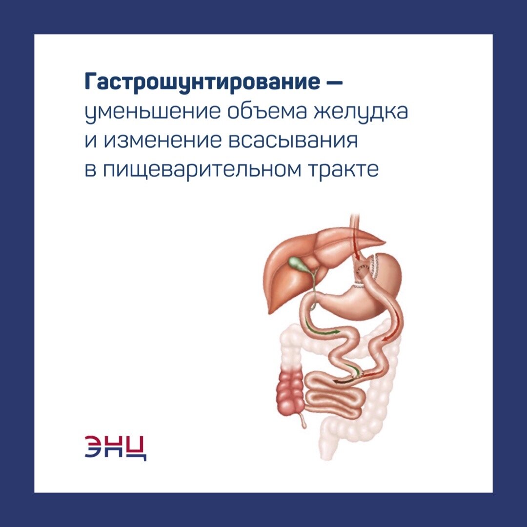 Хирургическое лечение ожирения. Какие способы существуют? | НМИЦ  эндокринологии | Дзен