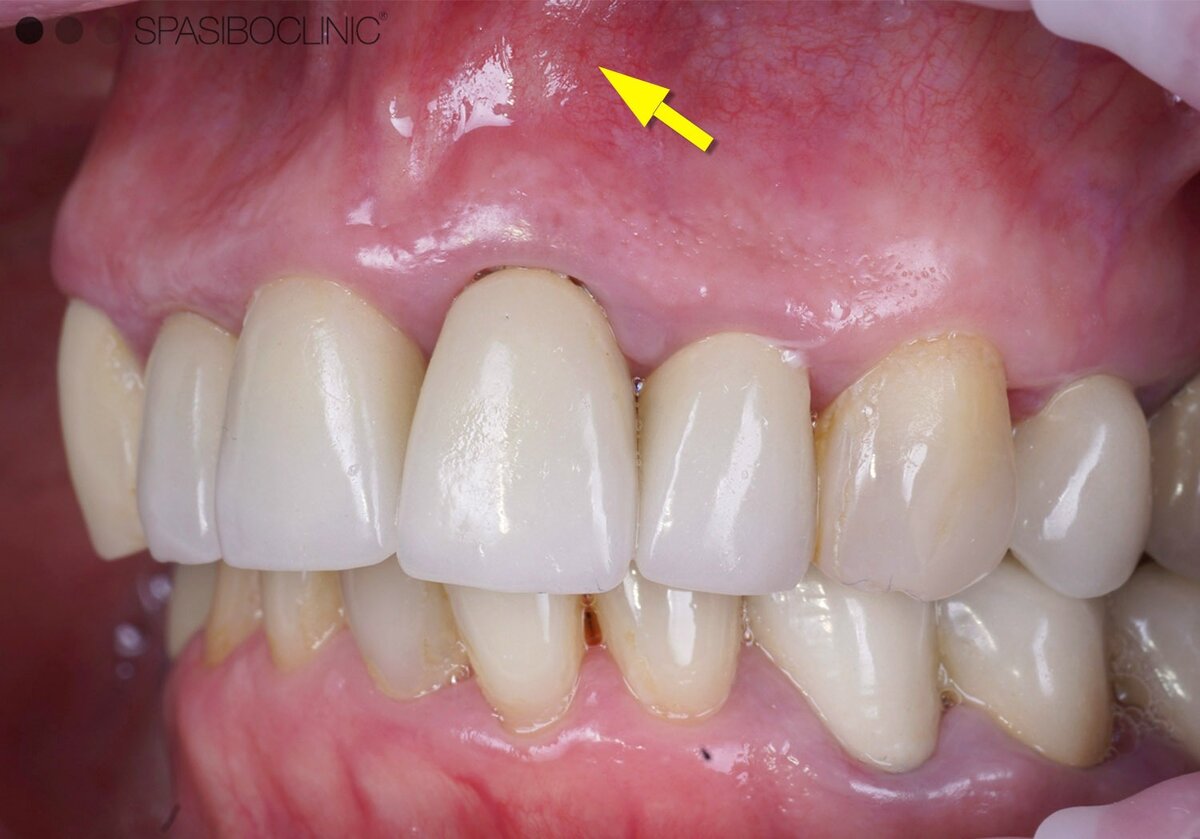 Воспалилась десна около коронки зуба – новости и статьи Refformat
