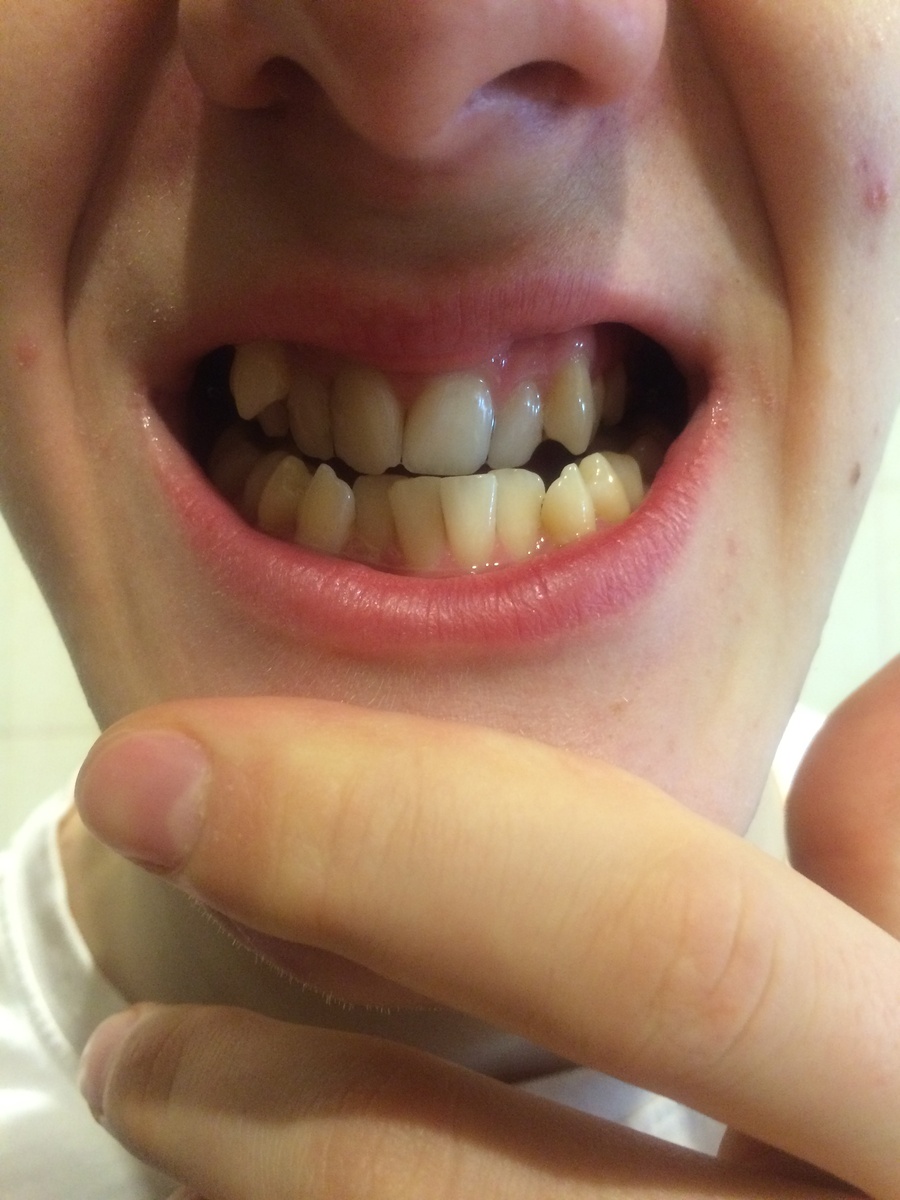 Фото от 20.02.2015- после лечения  и чистки зубиков. Установлен Винт-хайрекс.             Как видите, верхняя челюсть значительно меньше нижней.