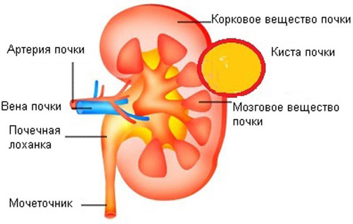 Киста печени: причины, симптомы, лечение