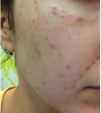Вот подобные синячки у меня были после мезотерапии. Фото из свободного доступа интернета.