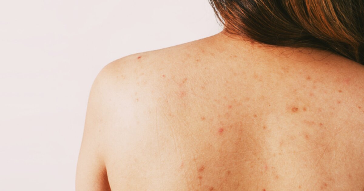 Вот такие высыпания были у меня. Дискомфорт доставляли не маленький.