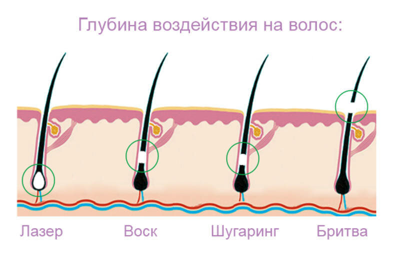 Сравнительная таблица-показывающая глубину воздействия на волос при различных методах удаления нежелательных волос.