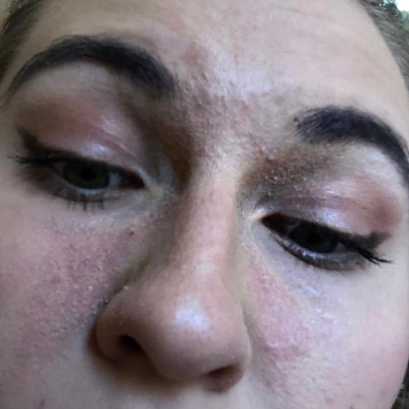 Расчесывала до ранок с корочкой 