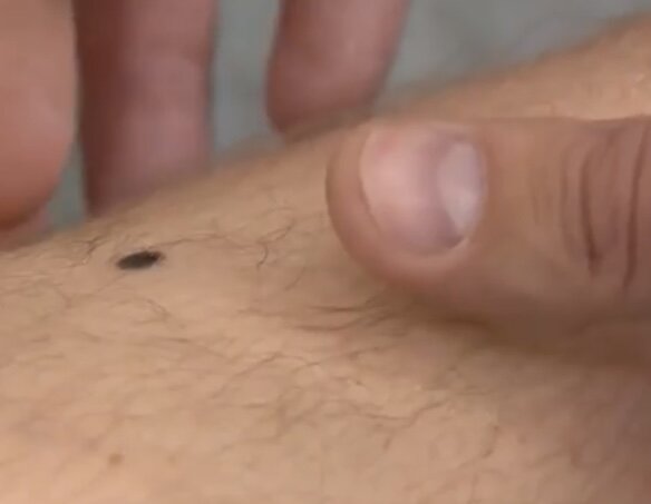 Как распознать опасные родинки?