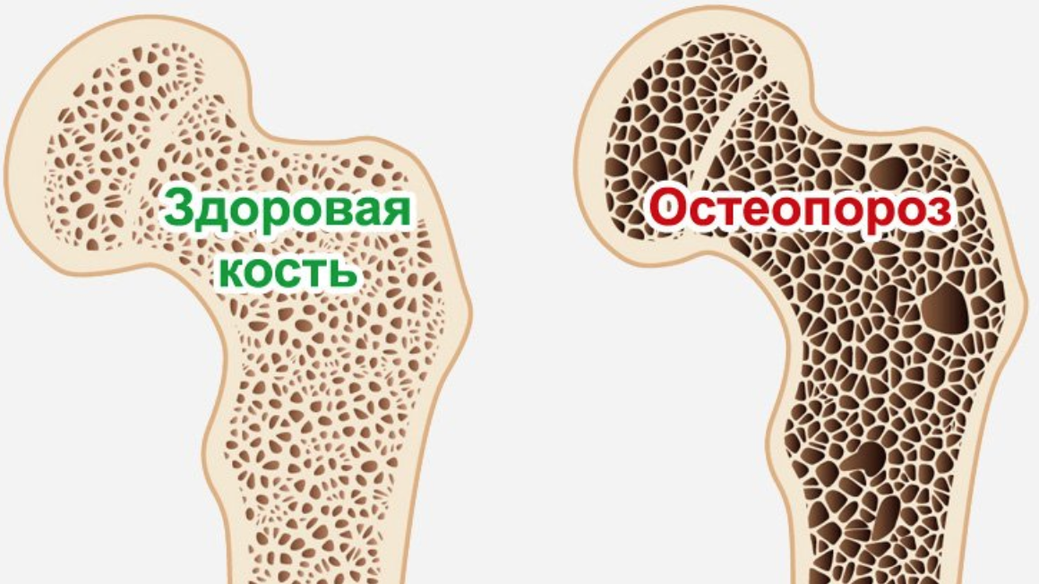 Здоровье костной ткани. Остеопороз. Здоровые кости. Остеопороз костей. Здоровая кость и остеопороз.