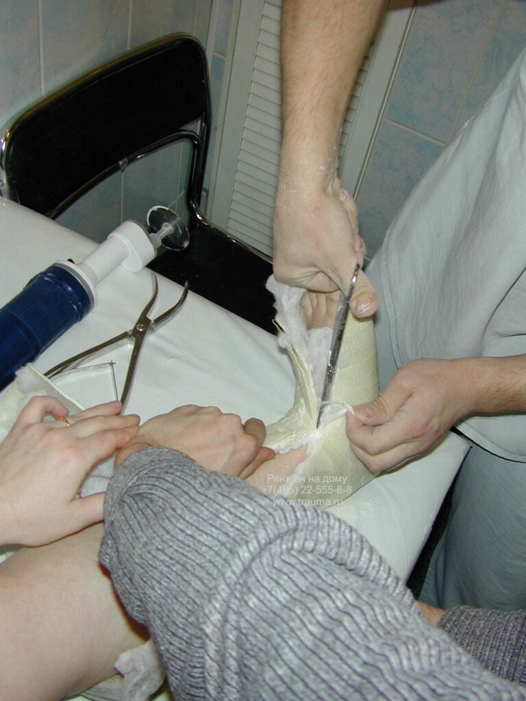 Пластиковый гипс снять сложнее, чем обычный. Он в несколько раз прочнее и эластичнее. Для аккуратного разрезания пластикового гипса удобно использовать специальную осцилляторную пилу. Она похожа на пилу-болгарку и может испугать пациента.
Сначала проводится разметка линии разреза.


Травматолог показывает пациенту, что даже если пила коснется кожи, то она ее не разрежет, а в худшем случае оставит слабый белый след, как от проведения ногтем. Для убедительности безопасность пилы демонстрируется на себе.

При разрезе используются металлический шпатель для защиты, который по возможности подкладывается под линию разреза гипса. 
После аккуратного разреза всех слоев гипса края раздвигаются в стороны руками травматолога.

Нога пациента освобождена недостаточно и есть опасность при вынимании конечности из гипса острыми краями повредить кожу. Для удобства вынимания делается еще один разрез осциляторной пилой.

Передняя часть гипса удаляется. Специальная гидрофобная вата под пластиковым гипсом разрезается ножницами с клювом, защищающим кожу пациента от повреждения. 

В области голеностопного сустава и особенно в области лодыжек контакт гипса с ногой пациента наиболее плотный. При наложении гипса травматолог старается именно в этих местах максимально адаптировать иммобилизацию к конфигурации конечности. Лодыжки являются в повязке основными точками фиксации. При снятии полимерной повязки из-за этого возникают сложности. Для отделения пластика от ноги используются щипцы-клювы Вольфа. Травматолог аккуратно отгибает и постепенно ломает повязку.
 
Проводится дорезание самого сложного участка гипса на уровне сгиба голеностопного сустава. После окончательного разреза травматолог разводит края гипса в стороны и нога вынимается.

Кожа протирается спиртом для очищения от старой кожи и борьбы с запахом.
Не рекомендуется в первую неделю принимать ванную из-за опасности нарастания отека.
Аллергия на пластиковый гипс автору не встречалась. 
Пластиковый гипс с его достоинствами (легкость, прочность, автоматическое моделирование по конечности, возможность мочить, в том числе купаться в море) не используется широко в основном из-за бедности. 
Пластиковый гипс нерационально накладывать при нестабильном переломе, при вероятности того, что придется несколько раз переделывать гипсовую повязку. 
