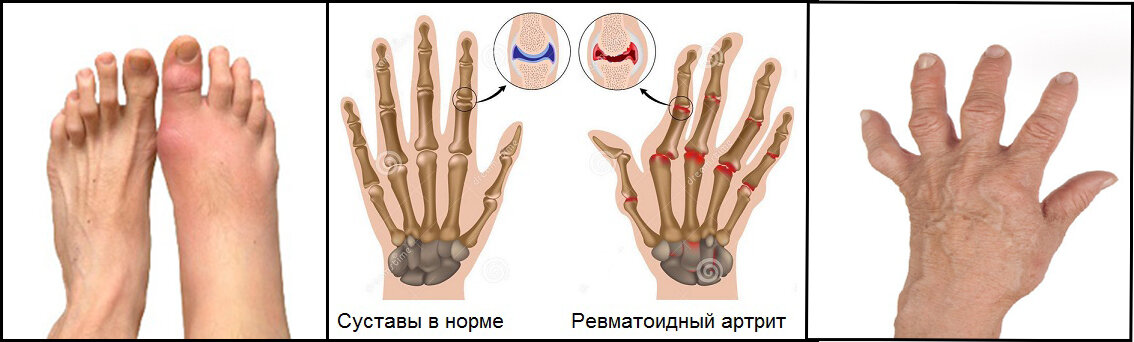 Амбулаторная карта ревматоидный артрит