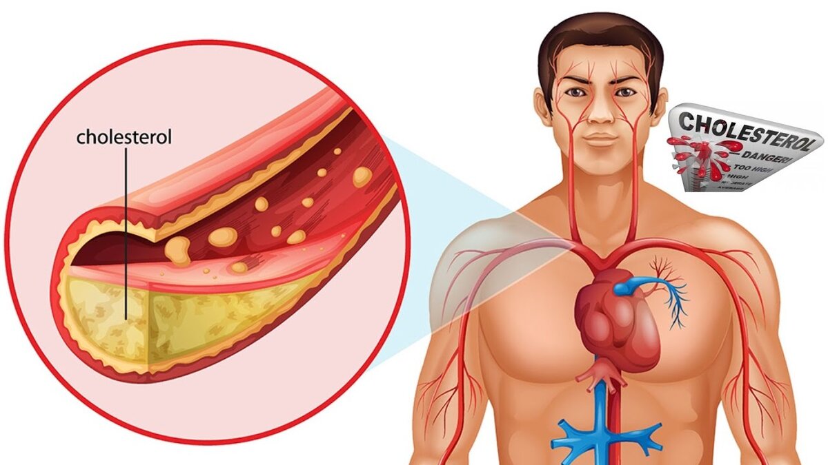 Локация холестерина
