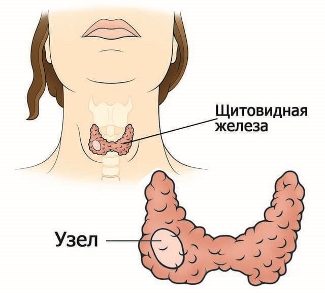 Заболевания щитовидной железы – лечение, причины, диагностика | ГКБ 71