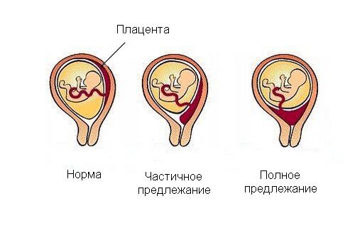 Симптомы повышенного тонуса матки