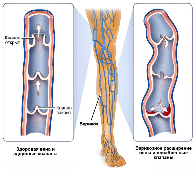 Варикозное расширение вен 
