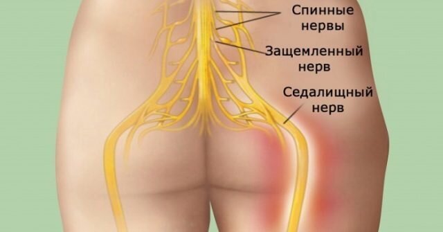 Защемление седалищного нерва — как снять боль? | Evolutis Clinic | Дзен