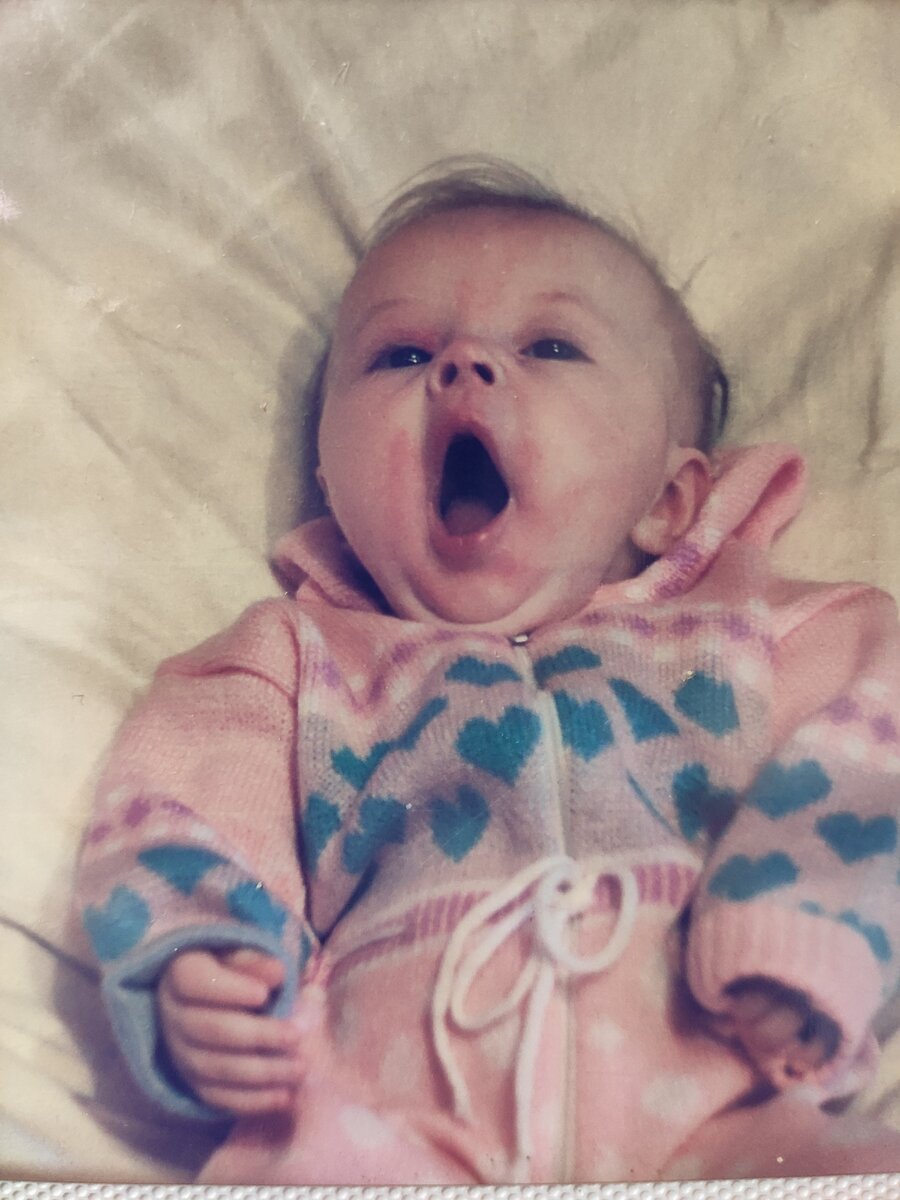 Фотографии из личного архива. Младенческая форма атопического дерматита.