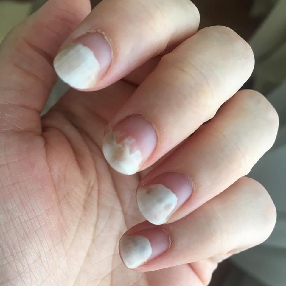 Белые пятна на ногтях: причины, лечение и профилактика