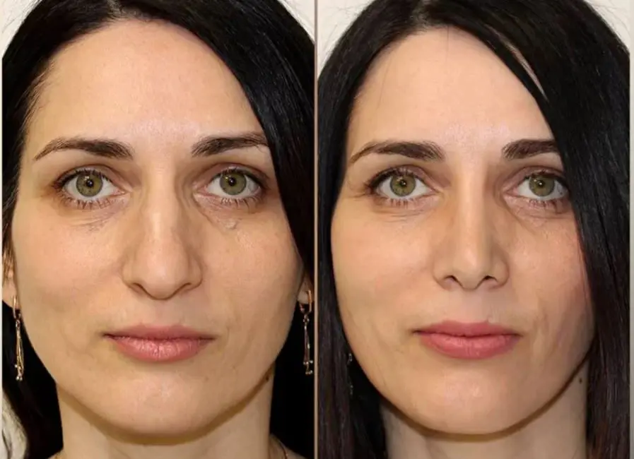 Ринопластика фото до и после. Фото с сайта пластического хирурга Давита Испиряна. Имеются противопоказания, требуется консультация специалиста