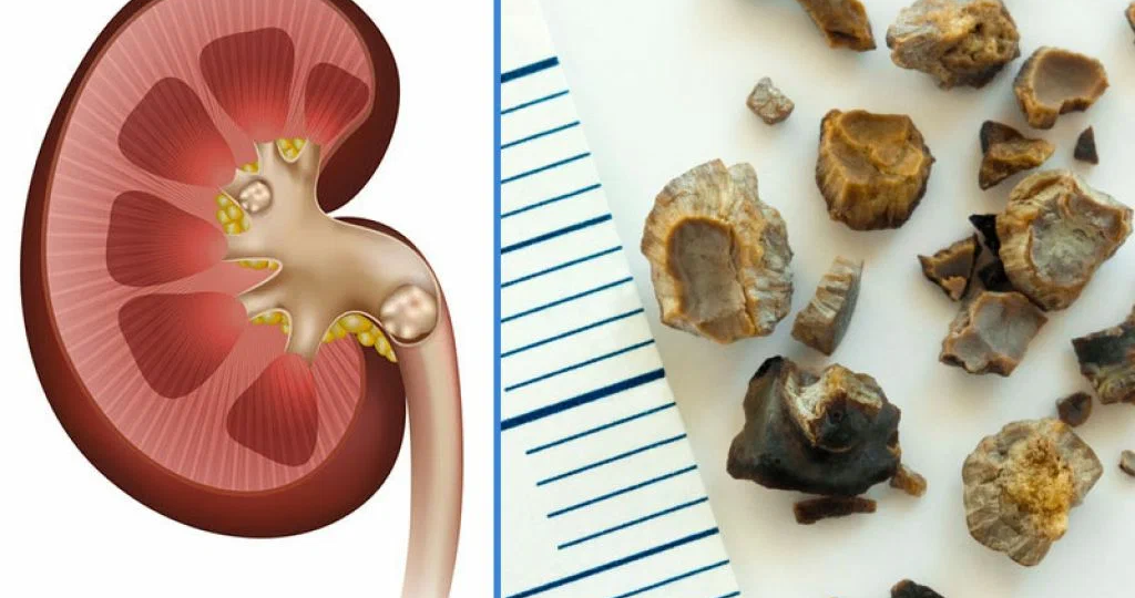 Камни в почках – откуда они: роль лишнего веса и воспаления, питания и солей мочи