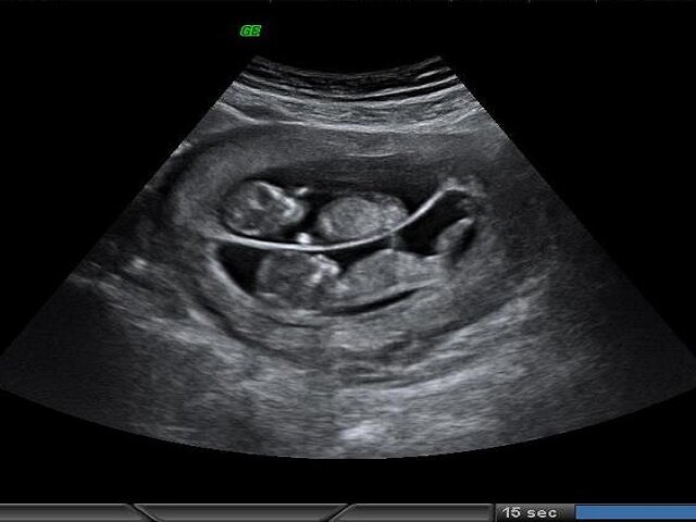 Фото УЗИ при беременности, фото плода при УЗИ во время беременности