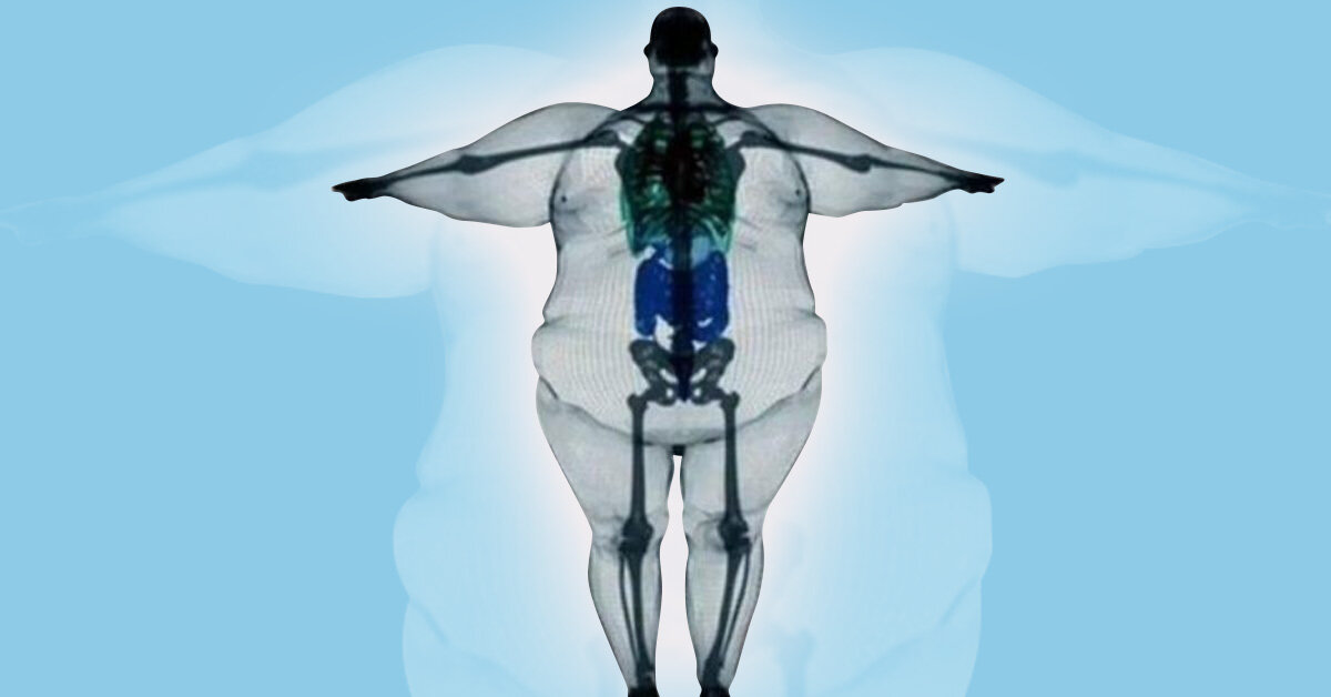 Широкая кость лица. Скелет Толстого человека рентген. Широкая кость. Толстый человек рентген. Реген Толстого человека.