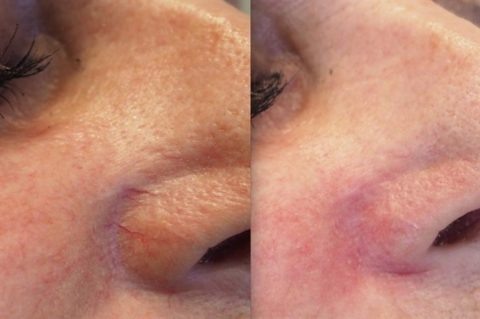 Фото до и после операции, и никакой телеангиоэктазии 