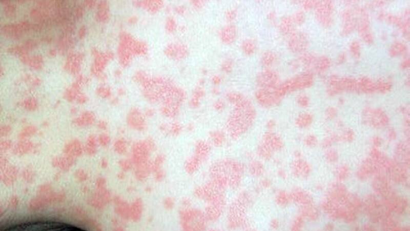 Макулопапулезная сыпь при коронавирусе у человека фото