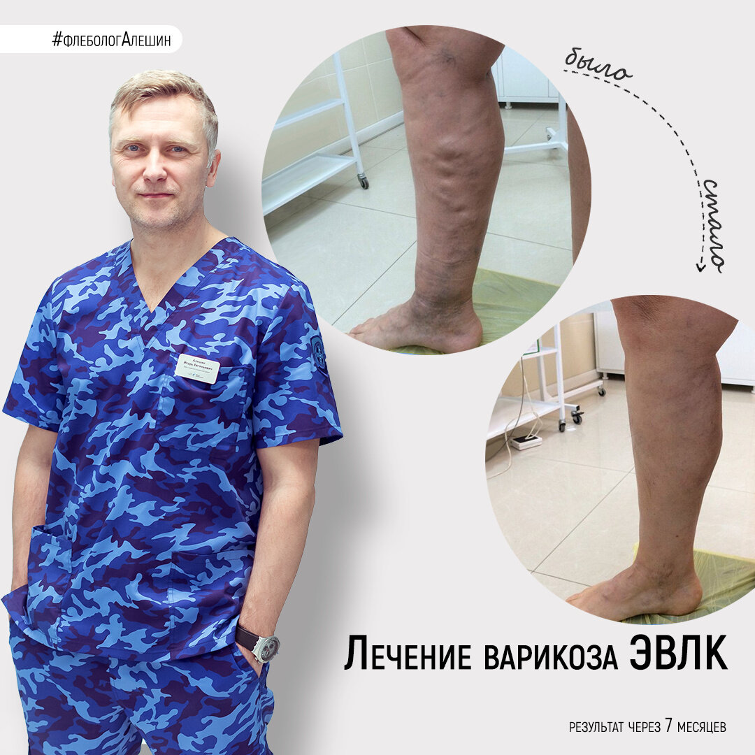Результаты лечения варикоза методом ЭВЛК
