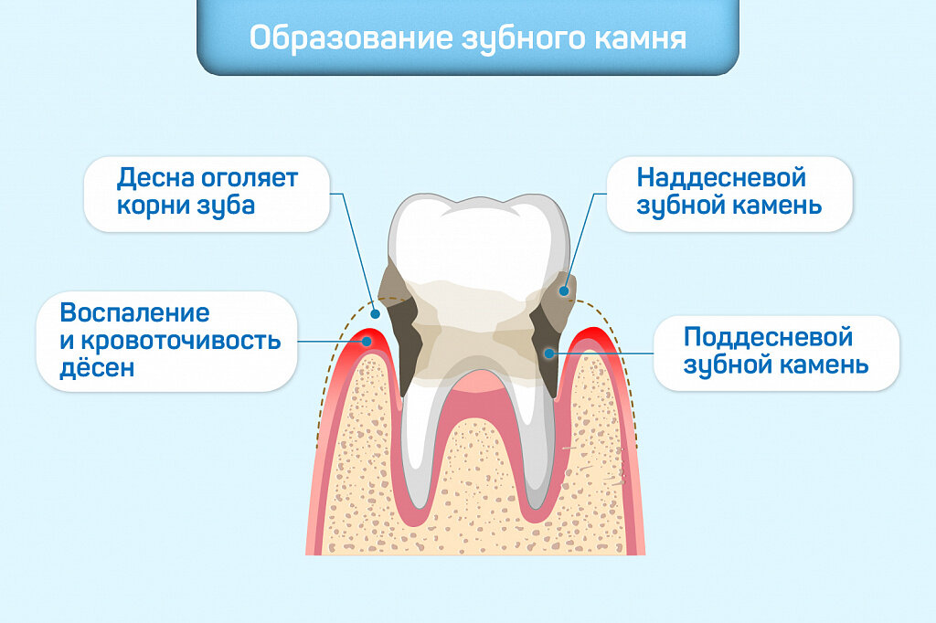 Схема развития воспалительных процессов в тканях окружающих зуб. 
