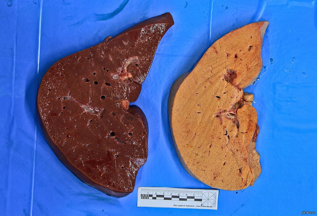 алкогольный гепатит и цирроз печени. нормальный цвет печени. стадии гепатоза печени. нормальный цвет печени. симптомы стадий фиброза печени.