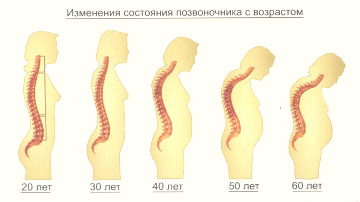 Стадии принятия остеохондроза картинка смешная
