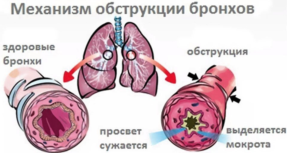 Не так страшен бронхит?