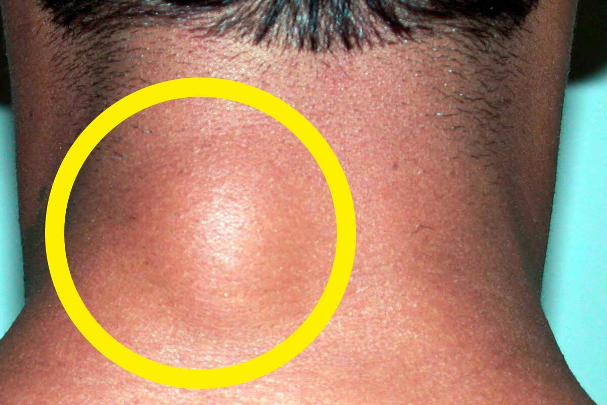 Жировик на шее