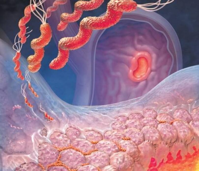 Лечение гастрита в домашних условиях, народные средства при обострениях, питание при гастрите