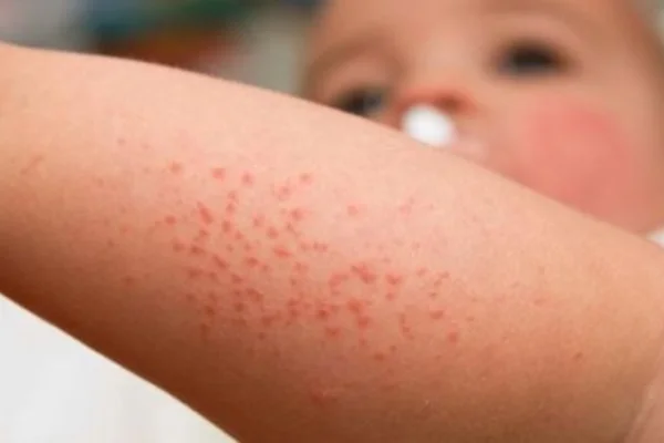 Пример сыпи при крапивнице