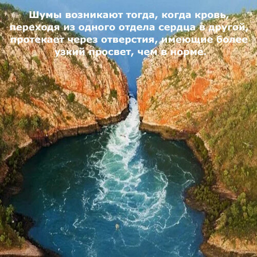 возникновение шума при стенозе