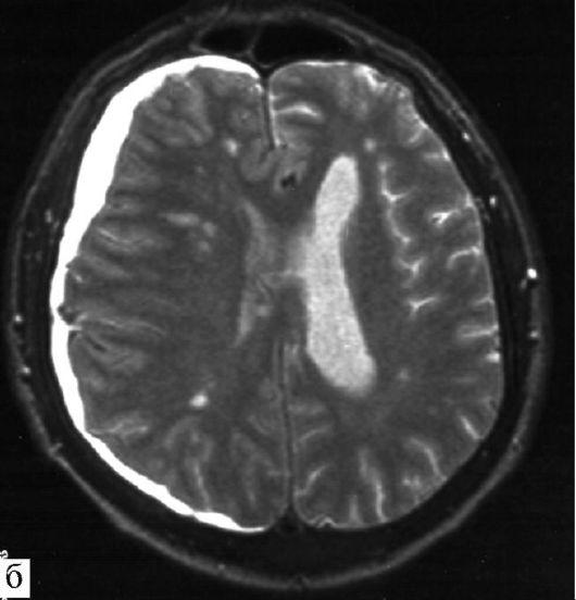 Лечение гематомы головного мозга