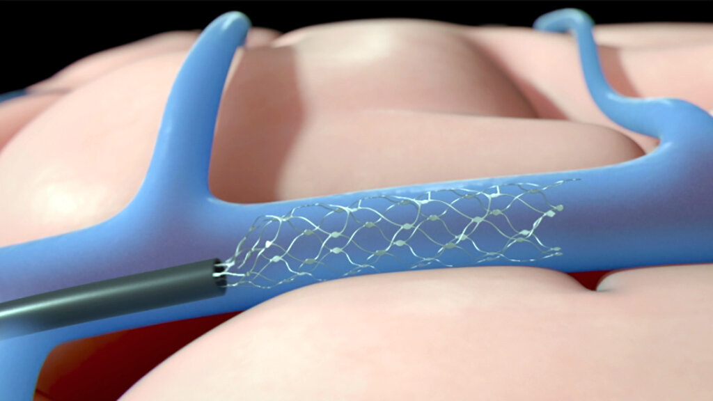 Ней­ро­ин­тер­фей­с компьютера  «Stent­rode»