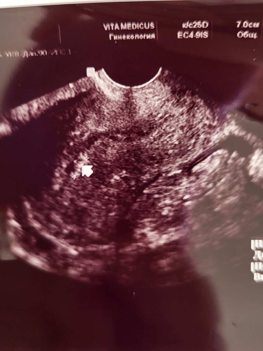 Это мои полипы 