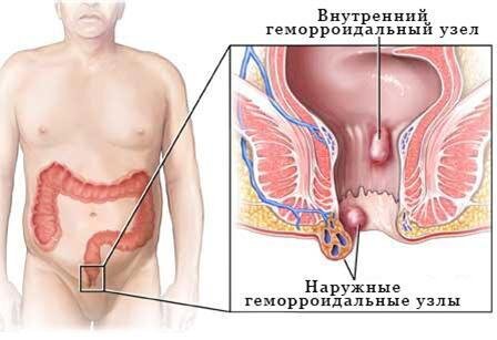 Проблема геморроя у беременных - ISIDA