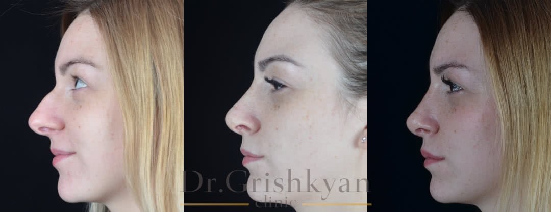 Удаление горбинки носа фото до и после. Фото с сайта Д.Р. Гришкяна. Имеются противопоказания, требуется консультация специалиста