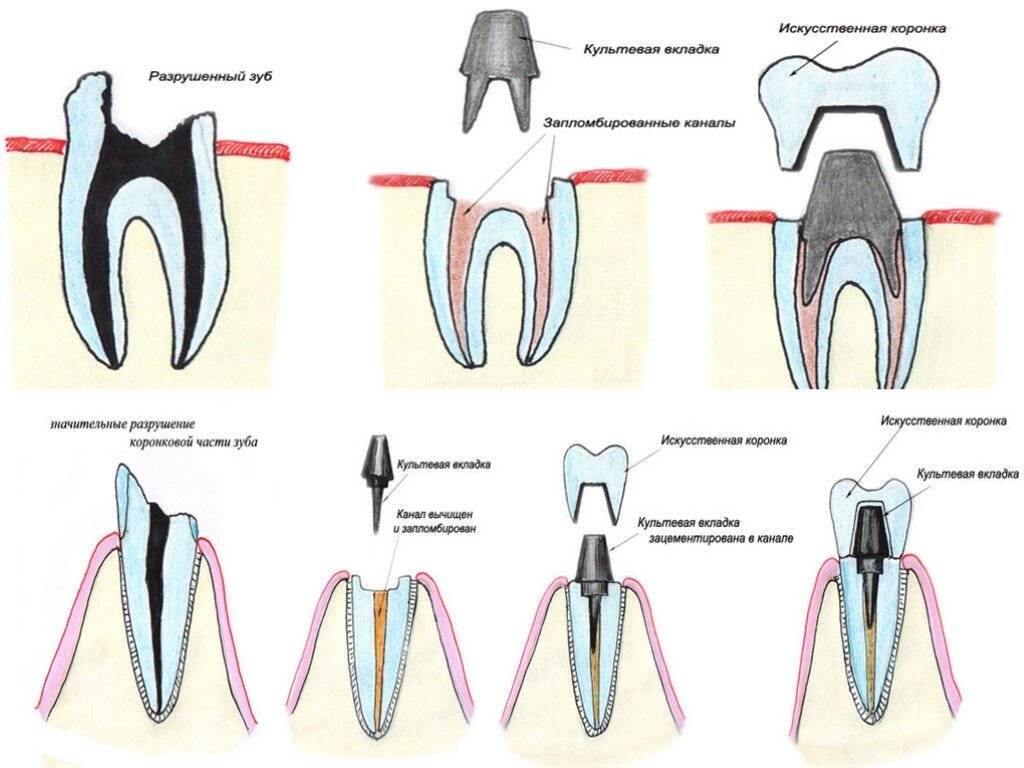 Что делать болит корень. Культевые штифтовые вкладки. Культевая вкладка штифт зуб. Штифтово культевая вкладка в зубе. Культевая Штифтовая конструкция.