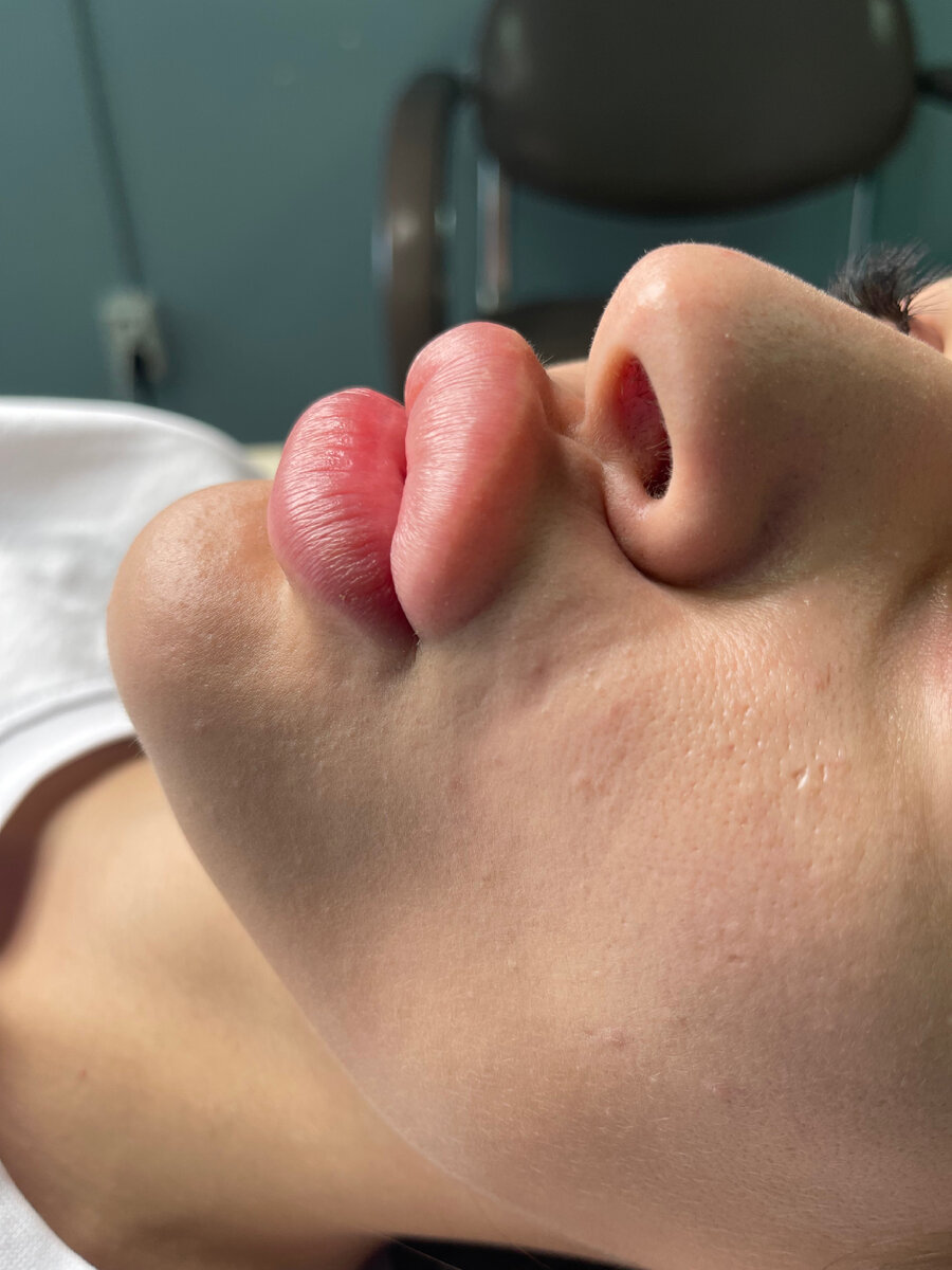 Так выглядит филлер который мигрировал в мышцу 