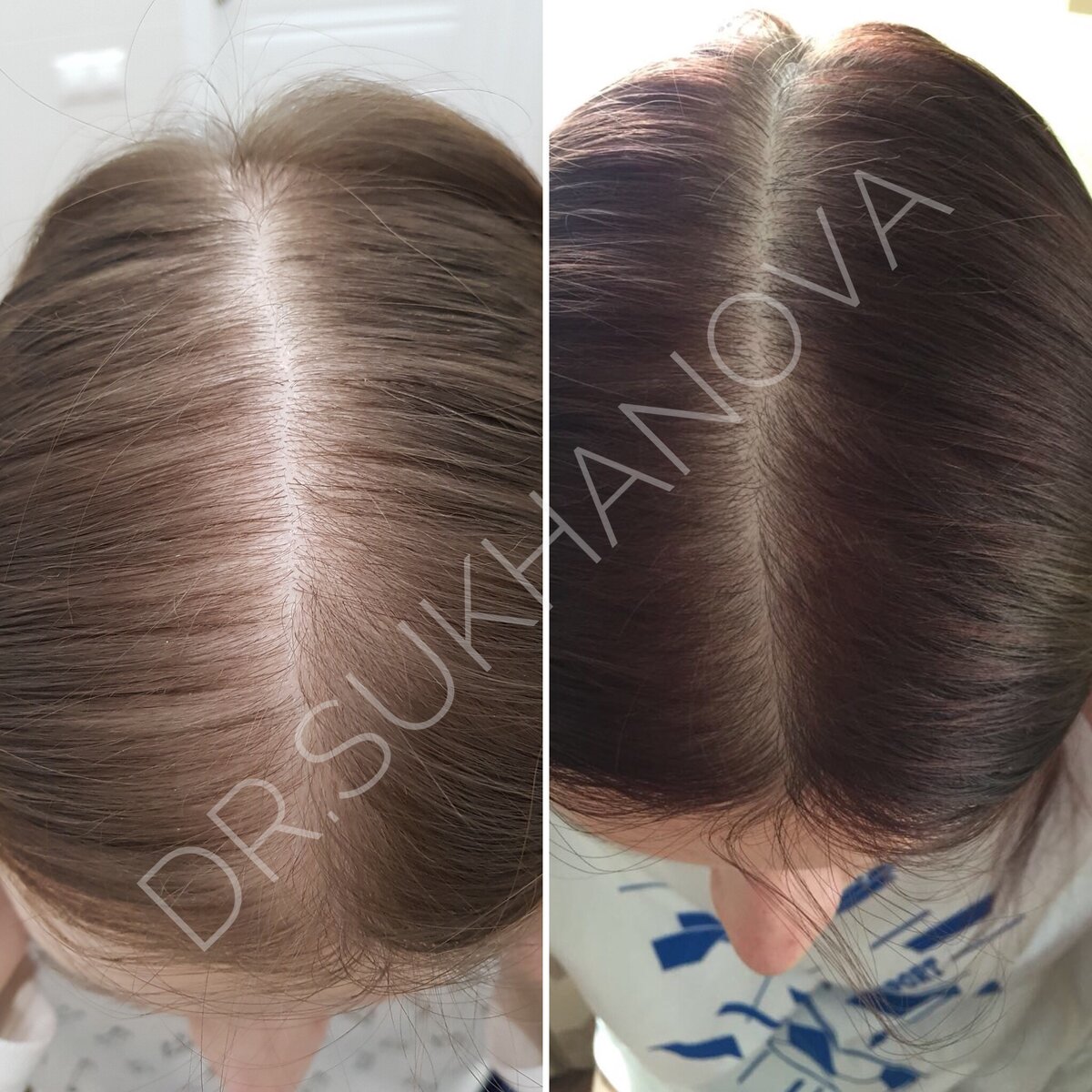 Андрогенетическая алопеция.