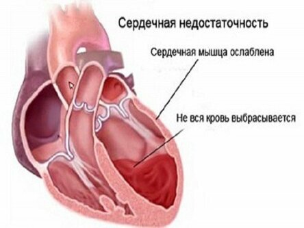 Аденома предстательной железы