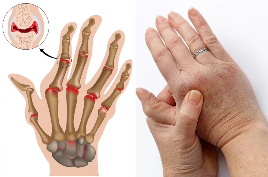 Ревматоидный артрит кисти. Фаланга ревматоидный артрит. Ревматоидный артрит запястного сустава. Анкилоз суставов пальцев.