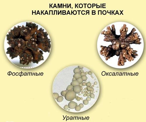 Конкременты в почках. Мочекаменная болезнь Ураты оксалаты. Ураты фосфаты оксалаты мочекаменная болезнь. Кальцифосфатные камни в почках. Мочекаменные болезни уратные камни.